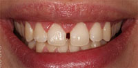 dents